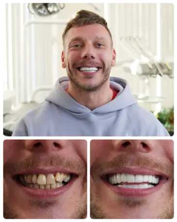 Hollywood Smile transformation — Bartosz